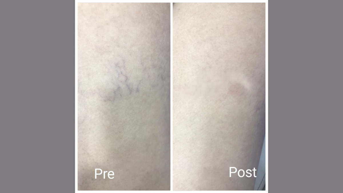 أفضل دكتور علاج الدوالي في الغردقة